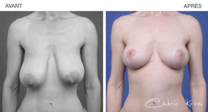 Avant - Après d'une chirurgie de correction de ptôse mammaire (vue de face)