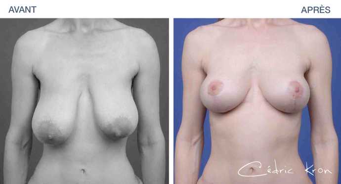 Before and after pictures of a breast lift surgery procedure