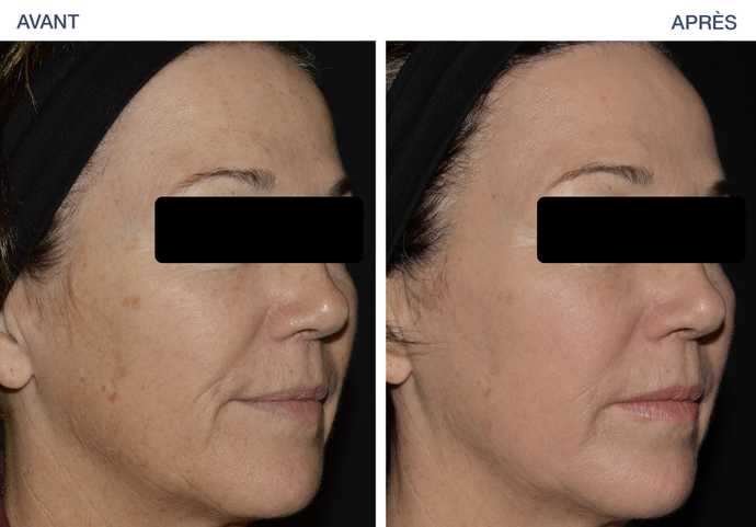 Avant-Après : Amelioration de la texture de la peau