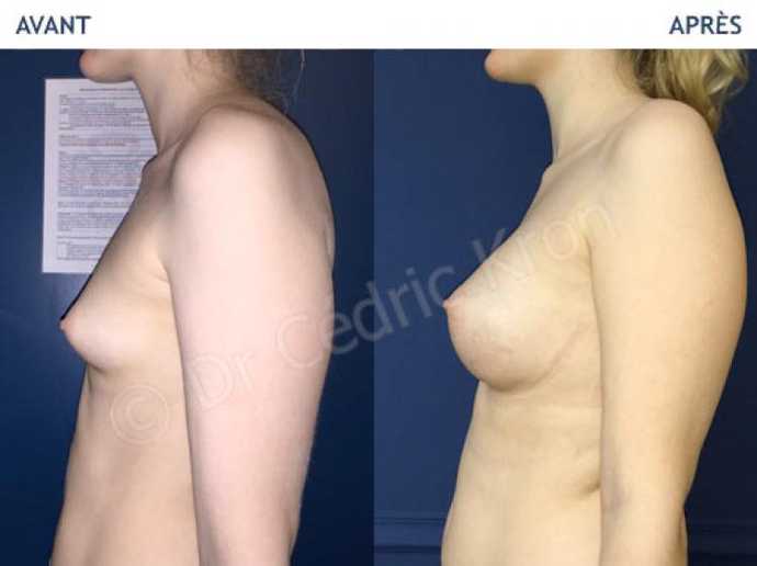 Before - After breast augmentation using implants