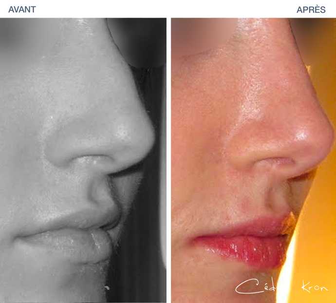 Before - After: results of rhinoplasty to remove a nasal hump