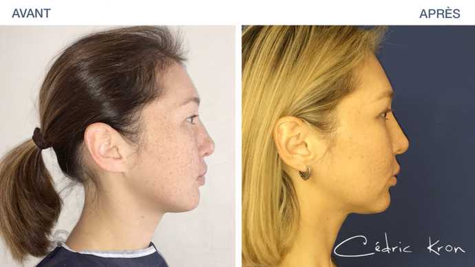 Before - After: results of rhinoplasty on Asian woman