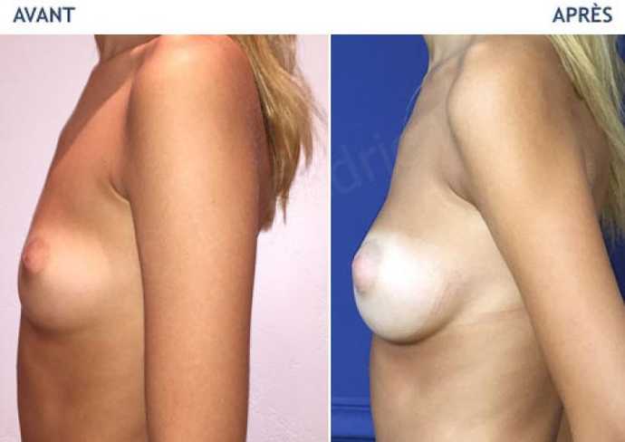 Before - After breast augmentation using implants