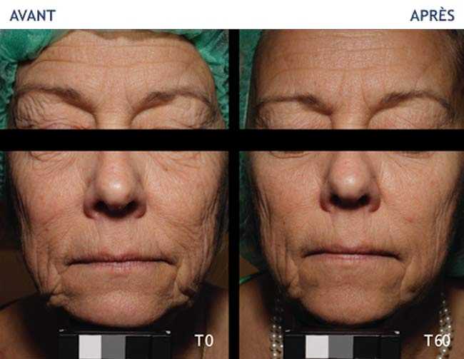   Avant - Après Universkin : Traitement des rides du visage et de la peau sèche