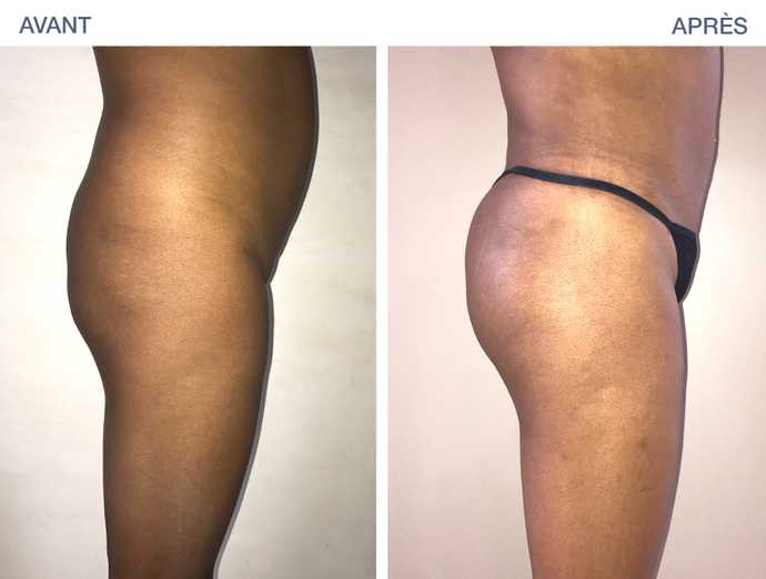 Before-after photo of a fat injection in the buttock area