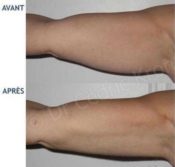 Before and after pictures of the result of upper-arm liposuction