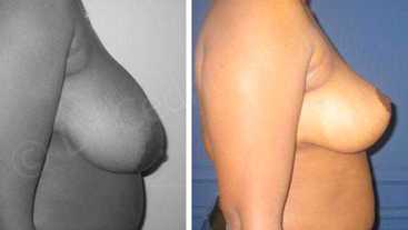 Avant-Après : Réduction mammaire