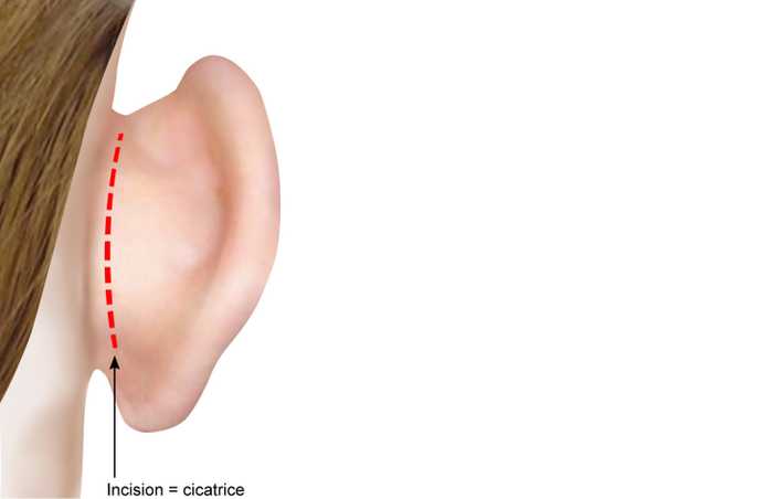 Emplacement de la cicatrice induite par une otoplastie ou chirurgie des oreilles décollées