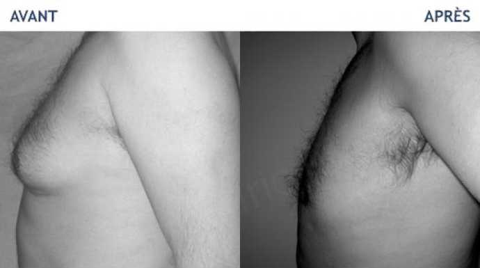 Avant - Après de traitements de la poitrine chez l'homme (Gynecomastie et Adipomastie)