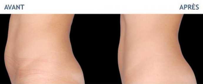 Before & After pictures of Cryolipolyse with Coolsculpting treatment