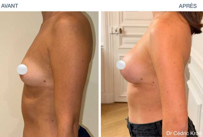 Résultat d'une augmentation mammaire avec Motiva Preservé chez une femme de 39 ans