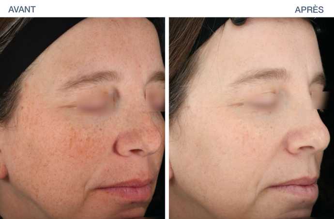 avant apres ultraclear 01