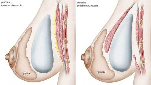 Surgical options for breast augmentation with prostheses