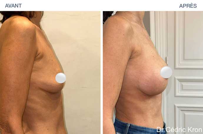 Résultat d'une augmentation mammaire avec prothèses Ergonomix 2 chez une femme de 52 ans