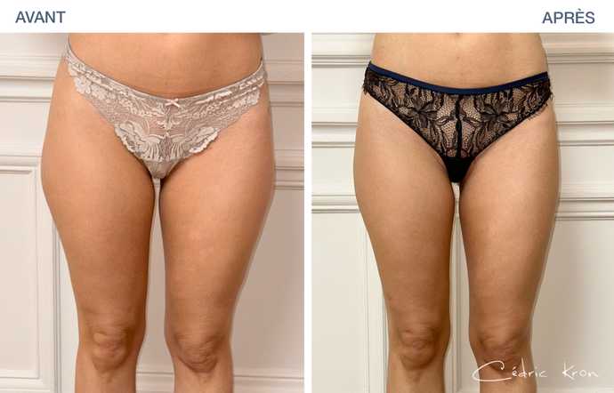 Avant - Après : Traitement de la culotte de cheval avec la Cryolipolyse Coolsculpting