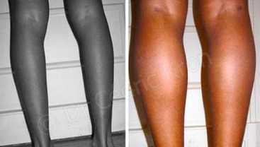 Before & After: Calf lipofilling