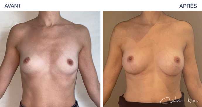 Avant-après : Résultat d'une augmentation mammaire avec des implants ronds