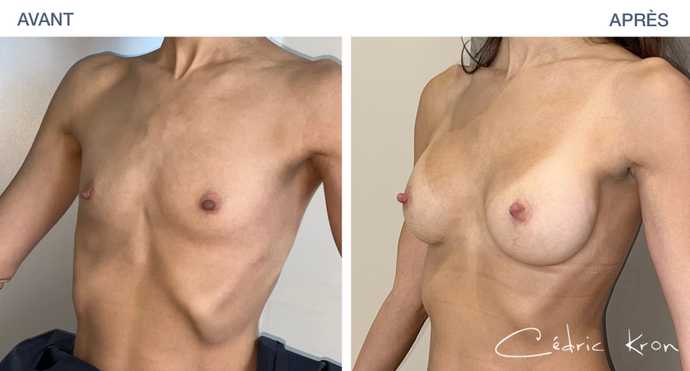 Avant-Après : Augmentation mammaire avec un résultat naturel à Paris