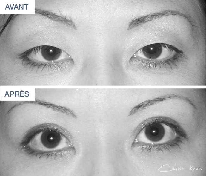 Photo avant-après d'une blépharoplastie pratiquée sur une femme asiatique