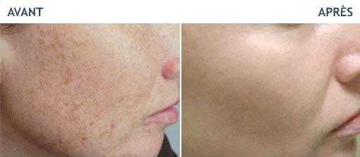 Correction of brown spots: Result of the intervention after 2 laser sessions