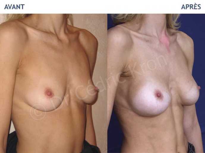 Before - After breast augmentation using implants