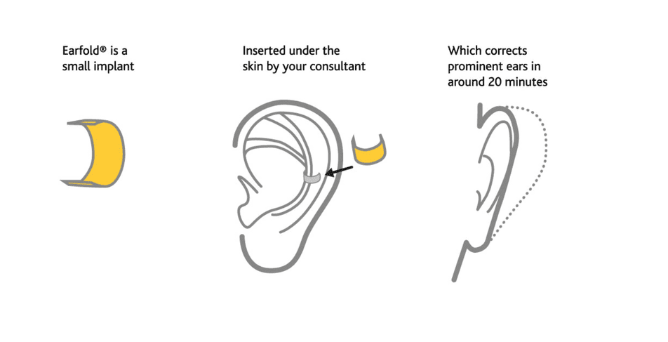 Implants earFold : une technique innovante pour recoller les oreilles