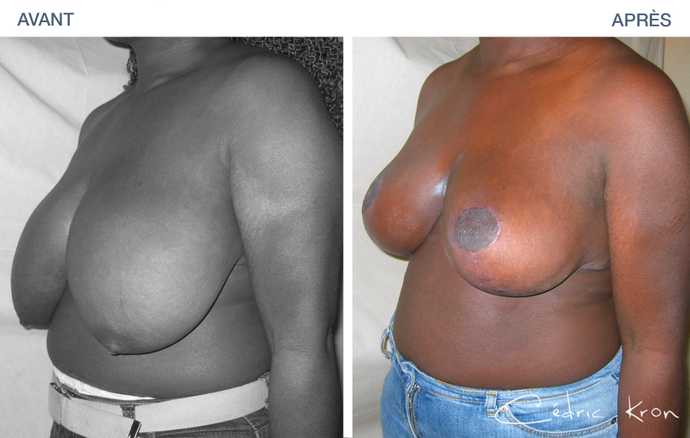 Photo avant-après d'une réduction mammaire pour corriger une hypertrophie des seins