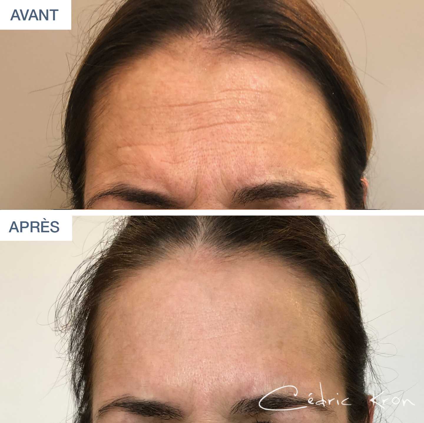 AvantAprès Traitement des rides du front par botox