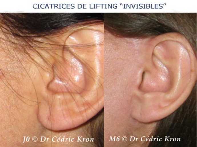 Avant - Après Lifting cervico-facial