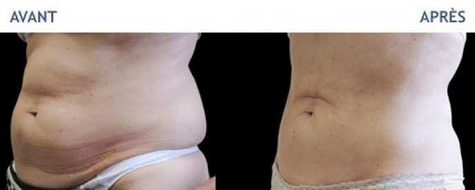 Before & After pictures of Cryolipolyse with Coolsculpting treatment