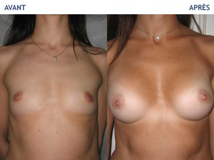 Before - After breast surgery