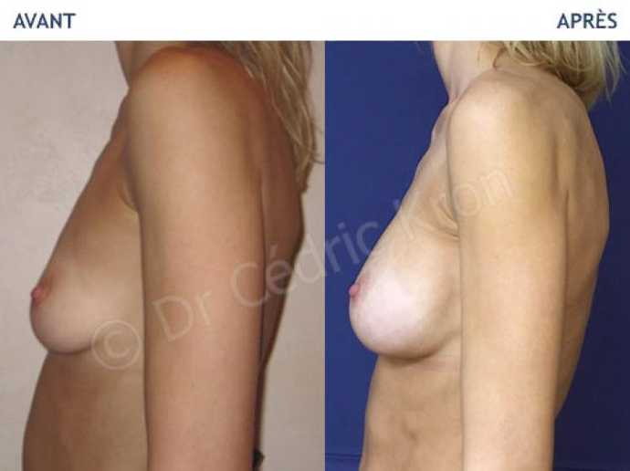 Before - After breast augmentation using implants