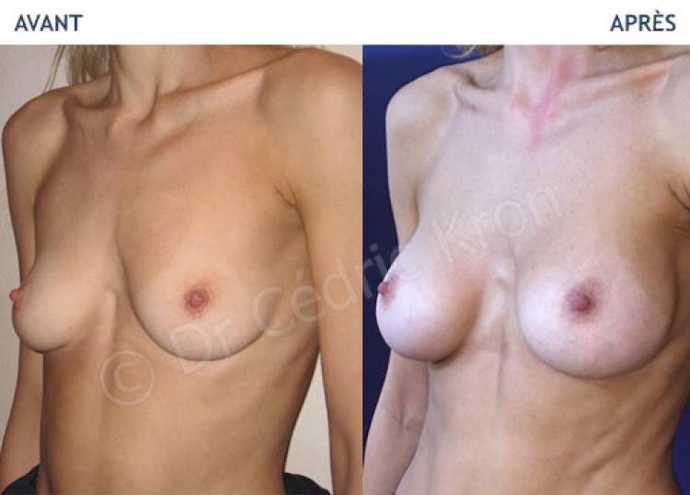 Before - After breast augmentation using implants