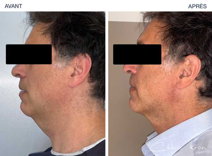 Avant - Après d'une suppression du double menton par lipoaspiration du cou