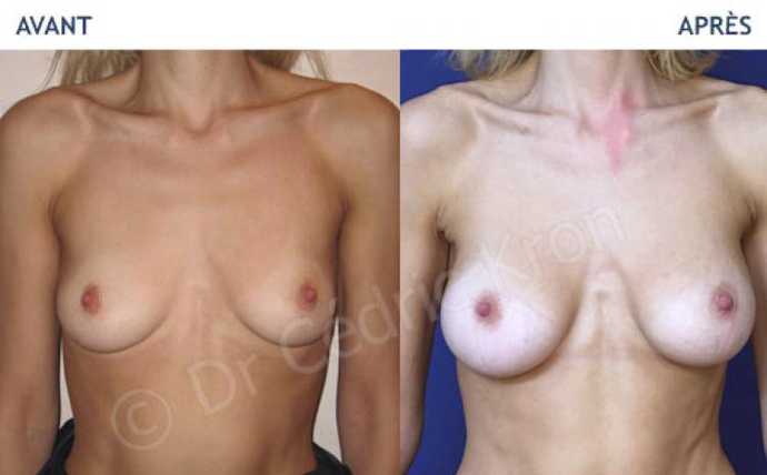 Before - After breast augmentation using implants