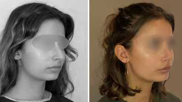 Avant-Après : Rhinoplastie - Chirurgie esthétiques du nez