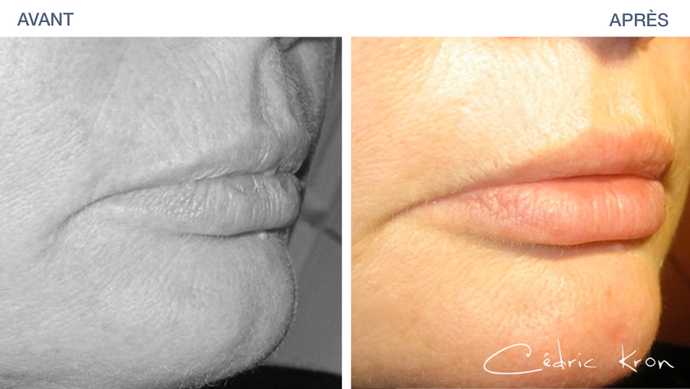 Avant - Après d'un lissage des lèvres par peeling et d'une augmentation de leur volume par injection acide hyaluronique