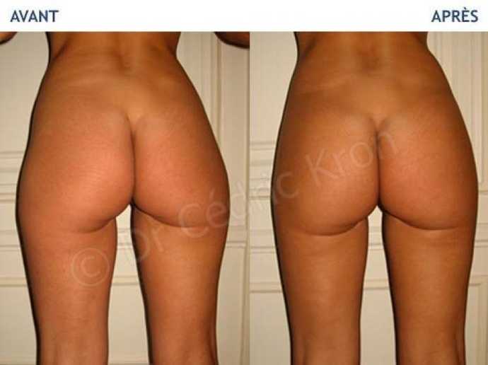 Avant - Après d'une chirurgie esthétique des fesses par lipostructure
