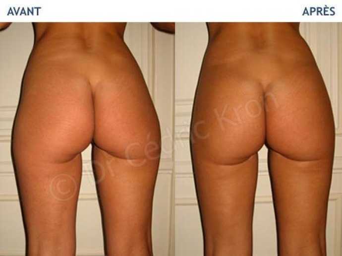 Before - After buttock plastic surgery using lipostructure