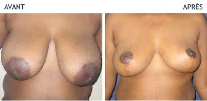 Before - After an aesthetic breast reduction surgery