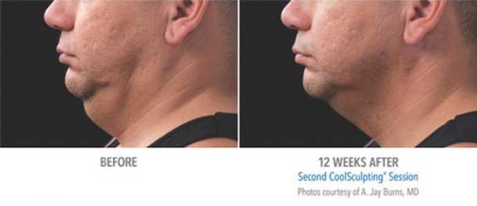 Before - After: removing double chin effect with Coolsculpting cryolipolysis technique