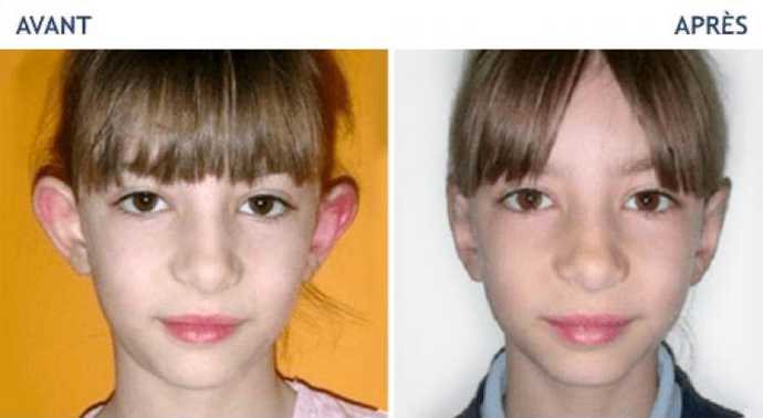 Before and after photos of prominent ears correction with earFold implants
