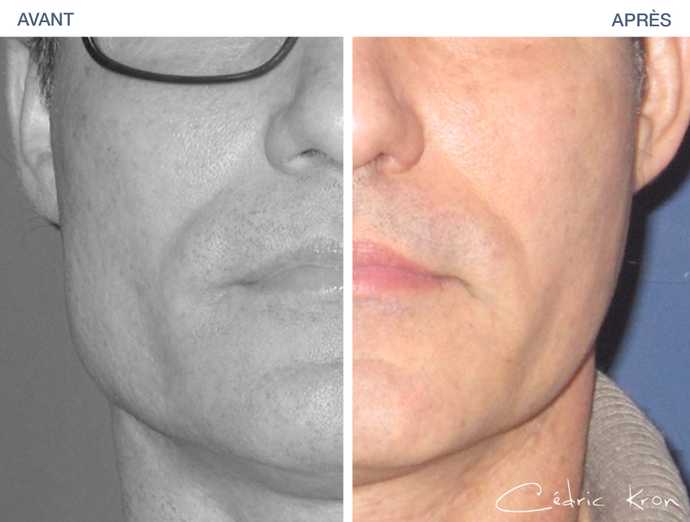 Before-After: jaw reduction using Botox injection on a man