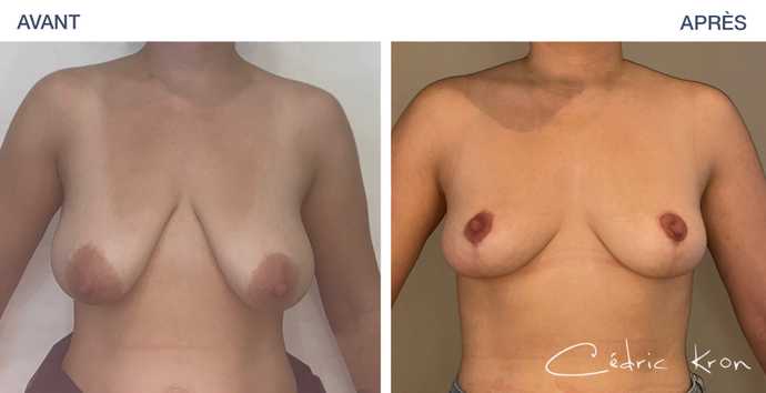 Avant - Apres d'une plastie mammaire réduction par le Dr Cédric Kron à Paris