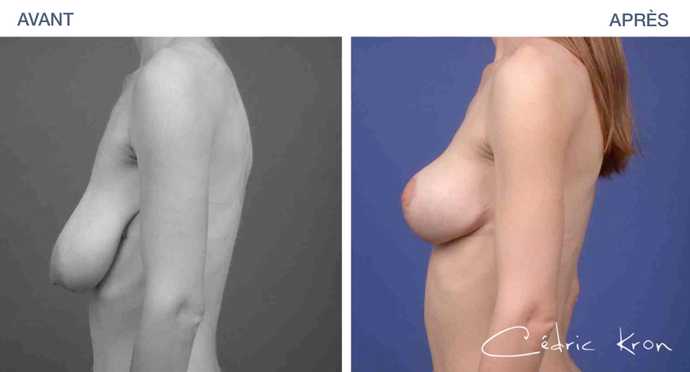 Avant - Après d'une chirurgie de correction de ptôse mammaire (vu de profil)