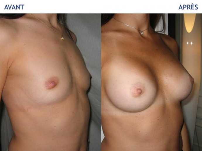 Before - After breast surgery