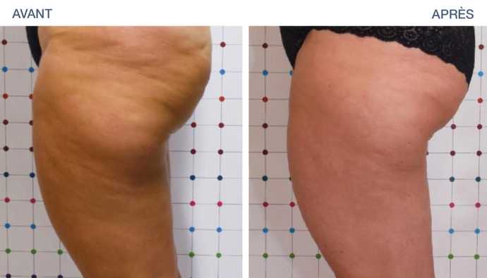 Résultat d'un traitement Onda Coolwave de la cellulite