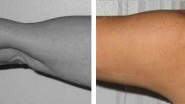 Avant-Après : Lipoaspiration des bras