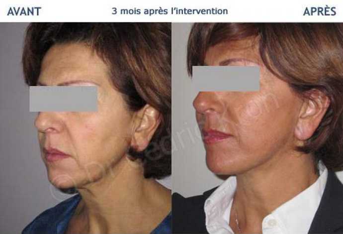 Avant - Après Lifting cervico-facial