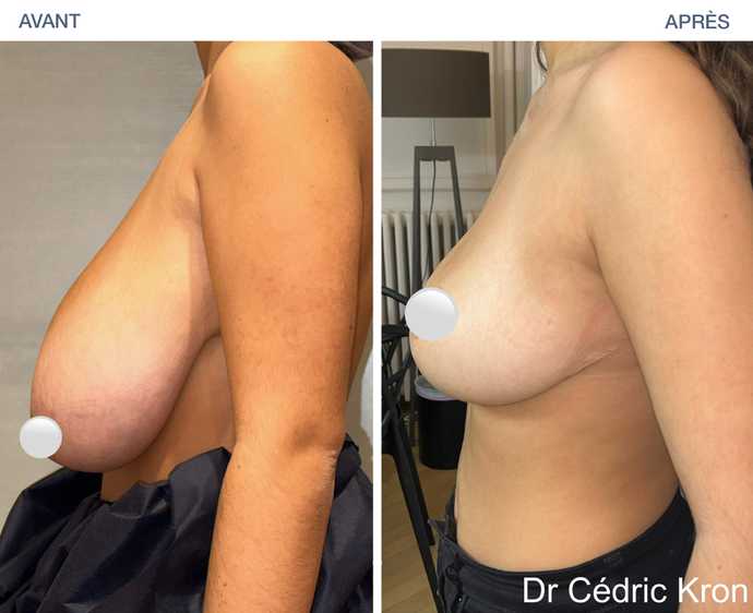 Avant - Apres d'une réduction mammaire par le Dr Kron à Paris